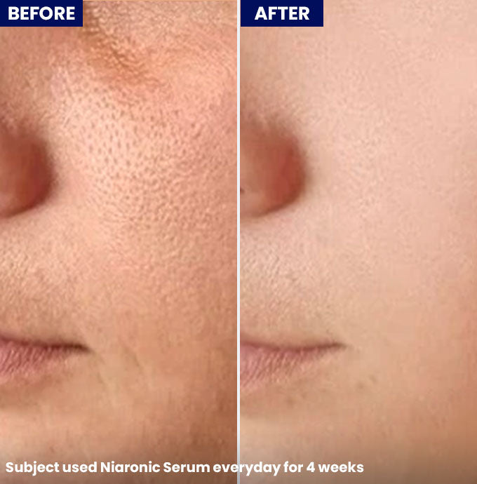 NiaRonic Serum (Pore Minimizing)
